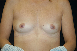 Breast Augmentation 3a
